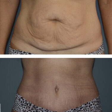 Before and after photos showing a woman's results after a tummy tuck (abdominoplasty) at Cho Plastic Surgery