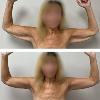 Double photo of woman's back with her arms up showing before and after arm lift surgery