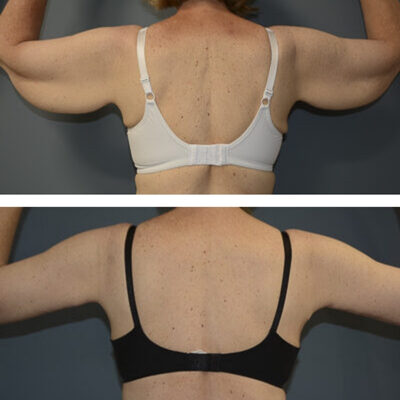Double photo of woman's back with her arms up showing before and after brachioplasty surgery