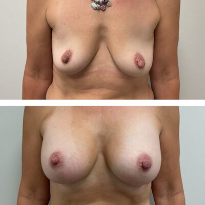 Two photos showing a woman's breasts before and after an augmentation mammoplasty