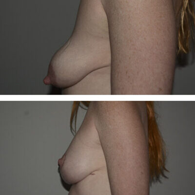 Two photos of a woman's breasts showing before and after a breast lift and breast augmentation