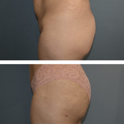 Two pictures from the side showing before and after a buttock augmentation