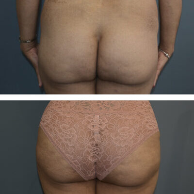 Two pictures from straight on showing before and after a buttock lift