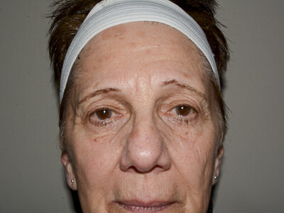 Close up of woman's face before a brow lift