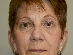 Close up of woman's face after a brow lift