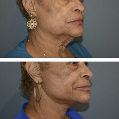 2 photos featuring a woman before and after a neck and facelift