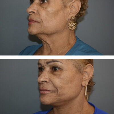 Two photos featuring a woman before and after a neck and facelift procedure
