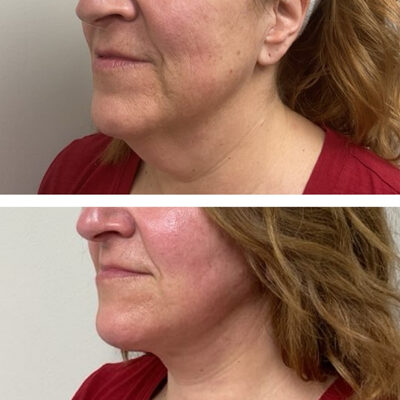 Two photos featuring a woman before and after a minimally invasive neck lift