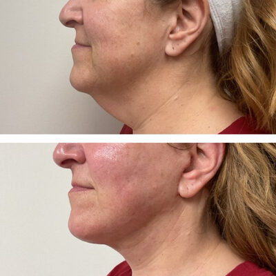 Two photos featuring a woman before and after a minimally invasive neck lift procedure