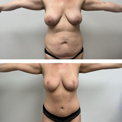 2 photos of a woman showing before and after results of a mommy makeover procedure