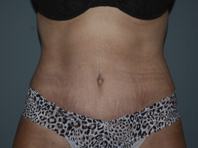 Close up photo of a woman's belly after a tummy tuck