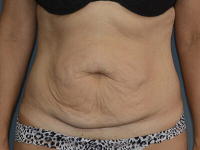 Close up photo of a woman's belly before a tummy tuck